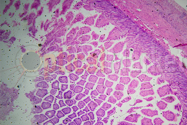 хроническое воспаление толстой кишки под микроскопом